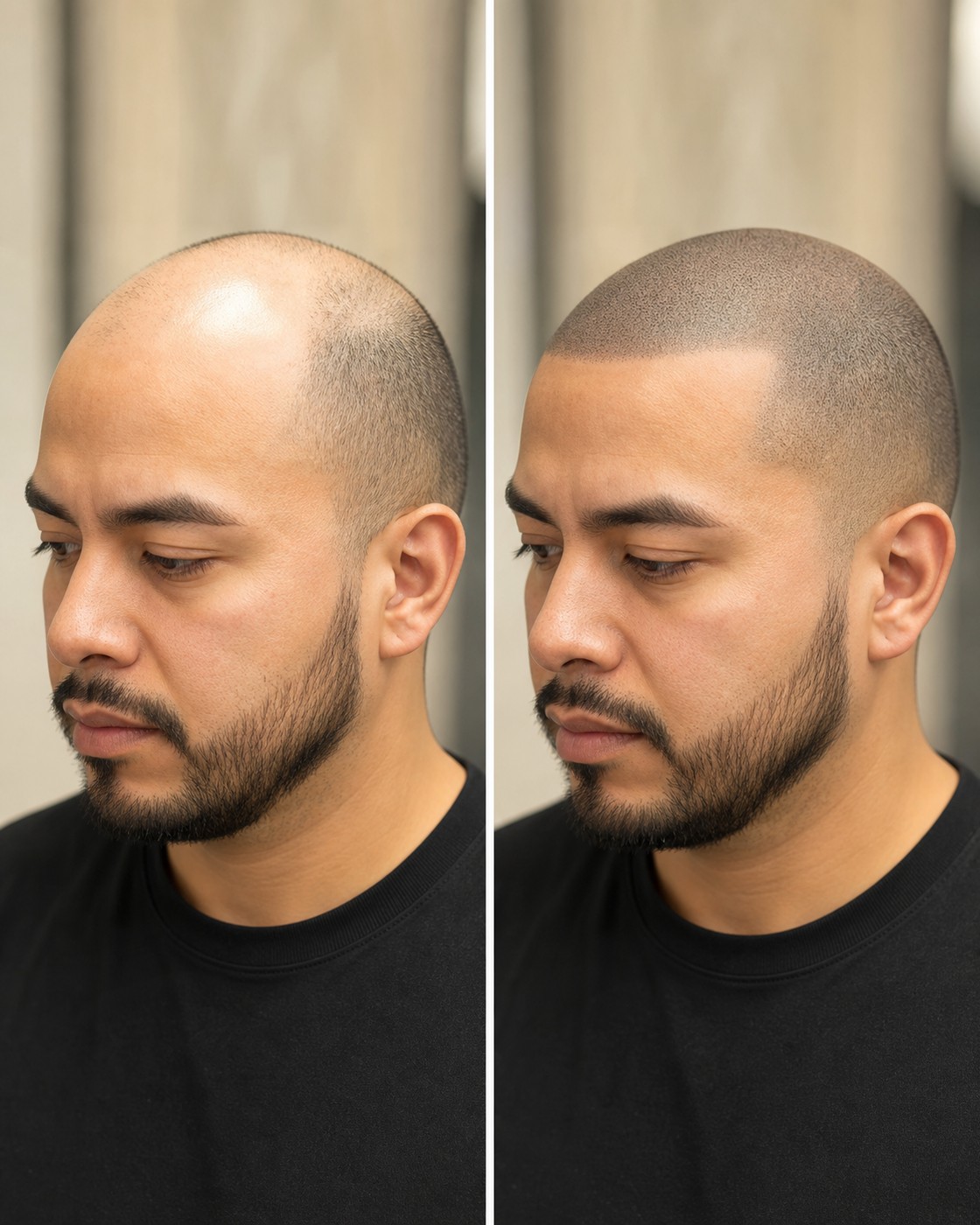 Before and after scalp micropigmentation — case 5